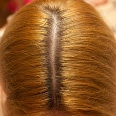 Androgenetische Alopezie - erblich bedingter Haarausfall