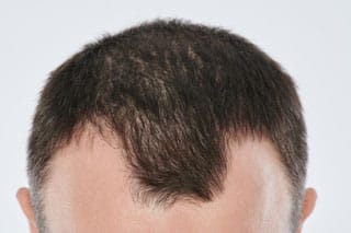 Geheimratsecken - Androgenetische Alopezie - erblich bedingter Haarausfall